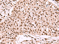 Immunohistochemistry of paraffin-embedded Human esophagus cancer tissue using SMAD7 Polyclonal Antibody at dilution of 1:40 (×200)