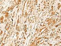 Immunohistochemistry of paraffin-embedded Human prost ate cancer tissue using TCF7 Polyclonal Antibody at dilution of 1:30 (×200)