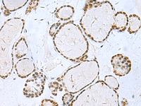 Immunohistochemistry of paraffin-embedded Human thyroid cancer tissue using TH Polyclonal Antibody at dilution of 1:40 (×200)