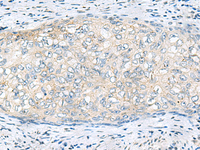 Immunohistochemistry of paraffin-embedded Human cervical cancer tissue using VEGFA Polyclonal Antibody at dilution of 1:60 (×200)