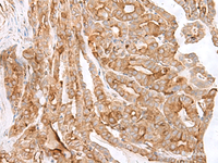 Immunohistochemistry of paraffin-embedded Human thyroid cancer tissue using MCAM Polyclonal Antibody at dilution of 1:40 (×200)