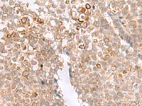 Immunohistochemistry of paraffin-embedded Human ovarian cancer tissue using MCAM Polyclonal Antibody at dilution of 1:40 (×200)