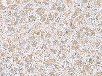 Immunohistochemistry of paraffin-embedded Human liver cancer tissue using NDRG4 Polyclonal Antibody at dilution of 1:45 (×200)