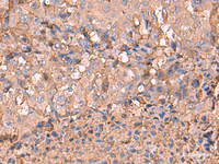 Immunohistochemistry of paraffin-embedded Human liver cancer tissue using NOTCH4 Polyclonal Antibody at dilution of 1:30 (×200)