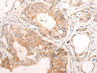 Immunohistochemistry of paraffin-embedded Human colorectal cancer tissue using HTRA1 Polyclonal Antibody at dilution of 1:55 (×200)