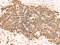 Immunohistochemistry of paraffin-embedded Human thyroid cancer tissue using CLK2 Polyclonal Antibody at dilution of 1:45 (×200)
