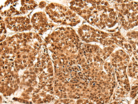 Immunohistochemistry of paraffin-embedded Human esophagus cancer tissue using NEK7 Polyclonal Antibody at dilution of 1:60 (×200)