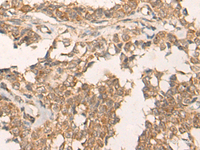 Immunohistochemistry of paraffin-embedded Human ovarian cancer tissue using ATR Polyclonal Antibody at dilution of 1:60 (×200)