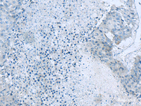 Immunohistochemistry of paraffin-embedded Human liver cancer tissue using GLS Polyclonal Antibody at dilution of 1:60 (×200)