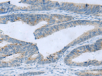 Immunohistochemistry of paraffin-embedded Human colorectal cancer tissue using GLS Polyclonal Antibody at dilution of 1:60 (×200)