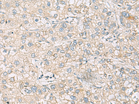 Immunohistochemistry of paraffin-embedded Human liver cancer tissue using RAC2 Polyclonal Antibody at dilution of 1:60 (×200)