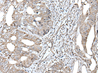 Immunohistochemistry of paraffin-embedded Human colorectal cancer tissue using RAD54B Polyclonal Antibody at dilution of 1:45 (×200)