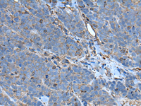 Immunohistochemistry of paraffin-embedded Human thyroid cancer tissue using SLC24A5 Polyclonal Antibody at dilution of 1:50 (×200)
