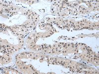 Immunohistochemistry of paraffin-embedded Human liver cancer tissue using TBX1 Polyclonal Antibody at dilution of 1:40 (×200)