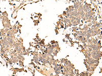 Immunohistochemistry of paraffin-embedded Human lung cancer tissue using SOX3 Polyclonal Antibody at dilution of 1:50 (×200)