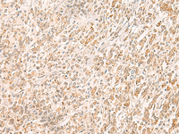 Immunohistochemistry of paraffin-embedded Human gastric cancer tissue using MYCT1 Polyclonal Antibody at dilution of 1:35 (×200)