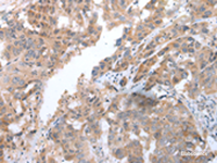 Immunohistochemistry of paraffin-embedded Human breast cancer tissue using COX7C Polyclonal Antibody at dilution of 1:40 (×200)