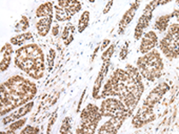Immunohistochemistry of paraffin-embedded Human esophagus cancer tissue using FOXG1 Polyclonal Antibody at dilution of 1:60 (×200)