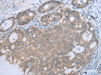 Immunohistochemistry of paraffin-embedded Human gastric cancer tissue using CCNG1 Polyclonal Antibody at dilution of 1:30 (×200)