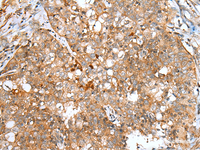 Immunohistochemistry of paraffin-embedded Human esophagus cancer tissue using DCX Polyclonal Antibody at dilution of 1:30 (×200)