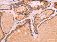 Immunohistochemistry of paraffin-embedded Human thyroid cancer tissue using GPC2 Polyclonal Antibody at dilution of 1:35 (×200)