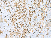 Immunohistochemistry of paraffin-embedded Human gastric cancer tissue using HOXC9 Polyclonal Antibody at dilution of 1:110 (×200)