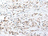 Immunohistochemistry of paraffin-embedded Human gastric cancer tissue using CHRNA5 Polyclonal Antibody at dilution of 1:50 (×200)