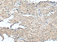 Immunohistochemistry of paraffin-embedded Human ovarian cancer tissue using MEF2D Polyclonal Antibody at dilution of 1:50 (×200)