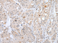 Immunohistochemistry of paraffin-embedded Human esophagus cancer tissue using BORCS8 Polyclonal Antibody at dilution of 1:50 (×200)