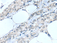 Immunohistochemistry of paraffin-embedded Human breast cancer tissue using MOG Polyclonal Antibody at dilution of 1:25 (×200)