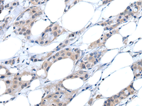 Immunohistochemistry of paraffin-embedded Human breast cancer tissue using ANGPTL6 Polyclonal Antibody at dilution of 1:55 (×200)