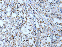 Immunohistochemistry of paraffin-embedded Human gastric cancer tissue using NF1 Polyclonal Antibody at dilution of 1:65 (×200)