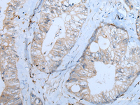 Immunohistochemistry of paraffin-embedded Human colorectal cancer tissue using CNTN1 Polyclonal Antibody at dilution of 1:55 (×200)