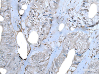 Immunohistochemistry of paraffin-embedded Human colorectal cancer tissue using ZNF703 Polyclonal Antibody at dilution of 1:40 (×200)