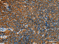 Immunohistochemistry of paraffin-embedded Human cervical cancer tissue using YBX1 Polyclonal Antibody at dilution of 1:25 (×200)