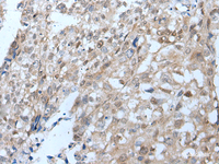 Immunohistochemistry of paraffin-embedded Human lung cancer tissue using VPS35 Polyclonal Antibody at dilution of 1:25 (×200)