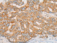 Immunohistochemistry of paraffin-embedded Human liver cancer tissue using ATXN7 Polyclonal Antibody at dilution of 1:60 (×200)