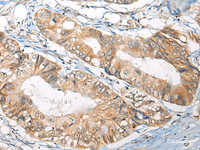 Immunohistochemistry of paraffin-embedded Human colorectal cancer tissue using B4GAT1 Polyclonal Antibody at dilution of 1:110 (×200)