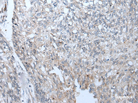 Immunohistochemistry of paraffin-embedded Human lung cancer tissue using BICD2 Polyclonal Antibody at dilution of 1:70 (×200)