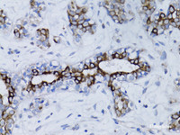 Immunohistochemistry of paraffin-embedded Human breast cancer using BRCA1 Polyclonal Antibody at dilution of 1:100 (40x lens) .