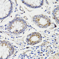 Immunohistochemistry of paraffin-embedded Human colon carcinoma using Caspase-8 Polyclonal Antibody at dilution of 1:200 (40x lens) .