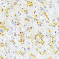 Immunohistochemistry of paraffin-embedded Human liver cancer using FAS Polyclonal Antibody at dilution of 1:100 (40x lens) .