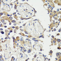 Immunohistochemistry of paraffin-embedded Human lung cancer using c-Fos Polyclonal Antibody at dilution of 1:150 (40x lens) .