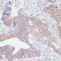 Immunohistochemistry of paraffin-embedded Human colon carcinoma using IKBKE Polyclonal Antibody at dilution of 1:200 (40x lens) .