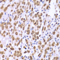 Immunohistochemistry of paraffin-embedded Human gastric cancer using Lamin A/C Polyclonal Antibody at dilution of 1:100 (40x lens) .