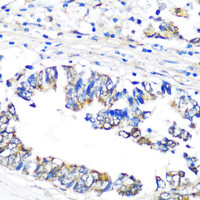 Immunohistochemistry of paraffin-embedded Human colon carcinoma using PBEF / NAMPT Polyclonal Antibody at dilution of 1:100 (40x lens) .