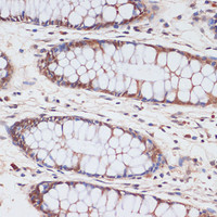 Immunohistochemistry of paraffin-embedded Human colon using CDKN2A / p16INK4a Polyclonal Antibody at dilution of 1:100 (40x lens) .
