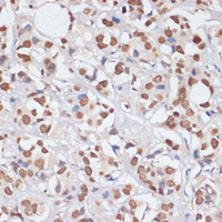 Immunohistochemistry of paraffin-embedded Human breast cancer using PCNA Polyclonal Antibody at dilution of 1:100 (40x lens) .
