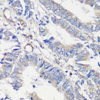 Immunohistochemistry of paraffin-embedded Human colon carcinoma using TNF-α Polyclonal Antibody at dilution of 1:100 (40x lens) .