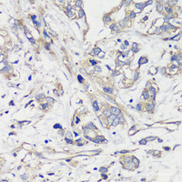 Immunohistochemistry of paraffin-embedded Human gastric cancer using TNF-α Polyclonal Antibody at dilution of 1:100 (40x lens) .